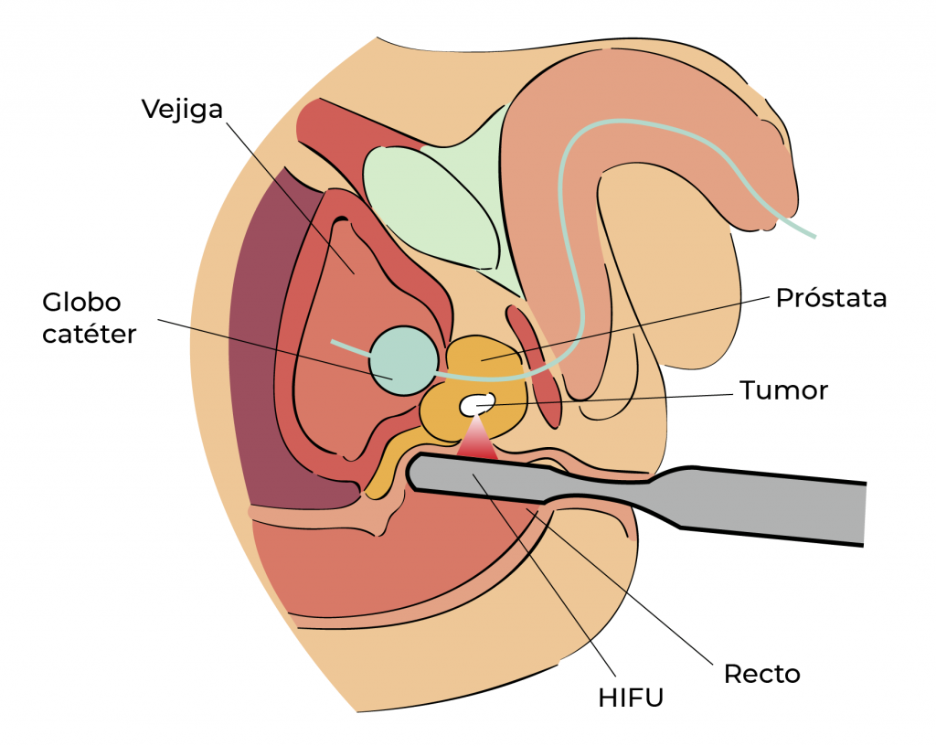 operacion cancer prostata hifu