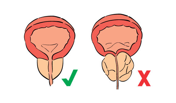 tumor benigno prostata operacion